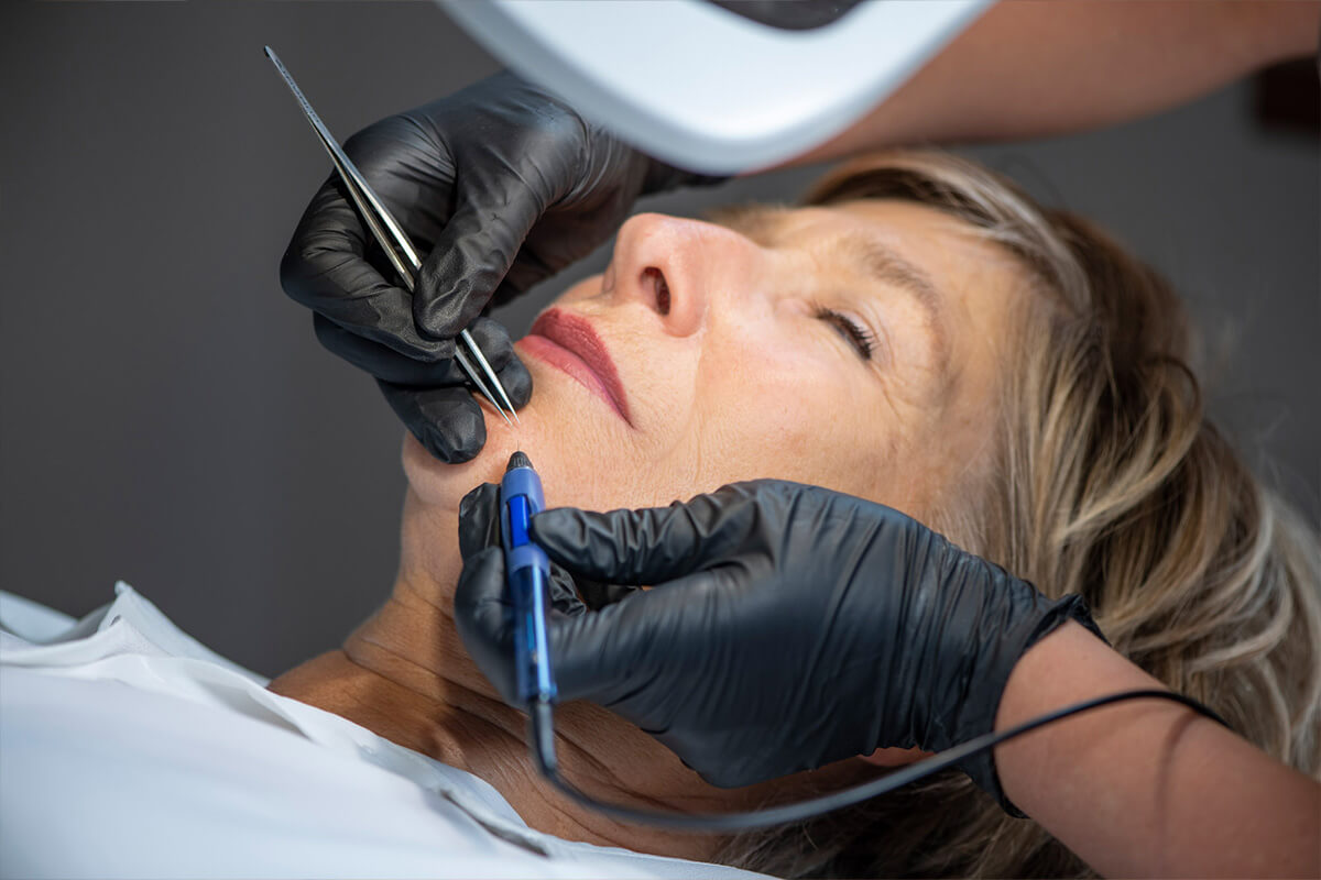 Elektrisch epileren van de kinharen