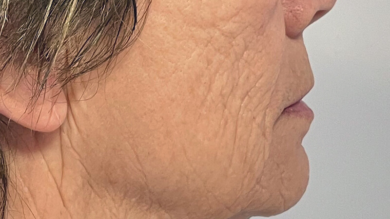 Microneedling RF na de behandeling