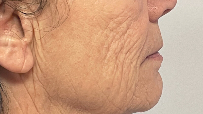 Microneedling RF voor de behandeling