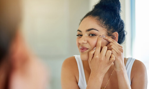 Acne is een vervelend huidprobleem