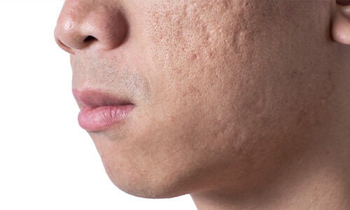 Acne littekens in het gezicht verminderen