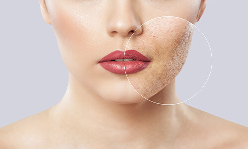 Acne littekens voor en na een behandeling