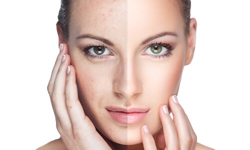Acne behandeling voor en na foto