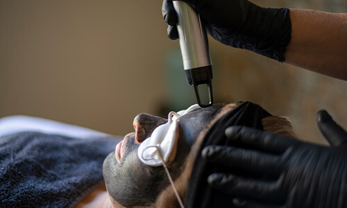 Carbon peeling voor het verjongen en diep reinigen van de huid