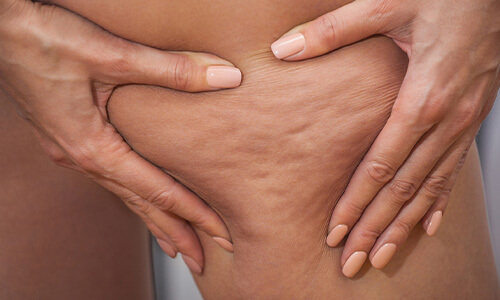 Cellulitis verminderen doormiddel van massage voor een betere doorbloeding