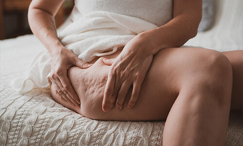 Cellulitis komt vaak voor op de bovenbenen en billen