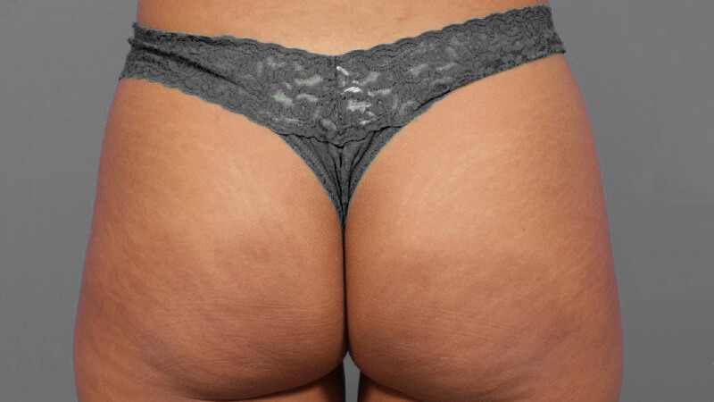 Cellulite verwijderen na de behandeling