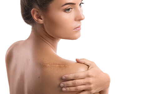 Littekens verminderen doormiddel van de microneedling rf
