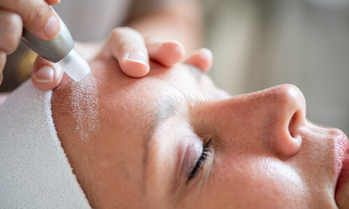 Microdermabrasie behandeling op het voorhoofd van een vrouw