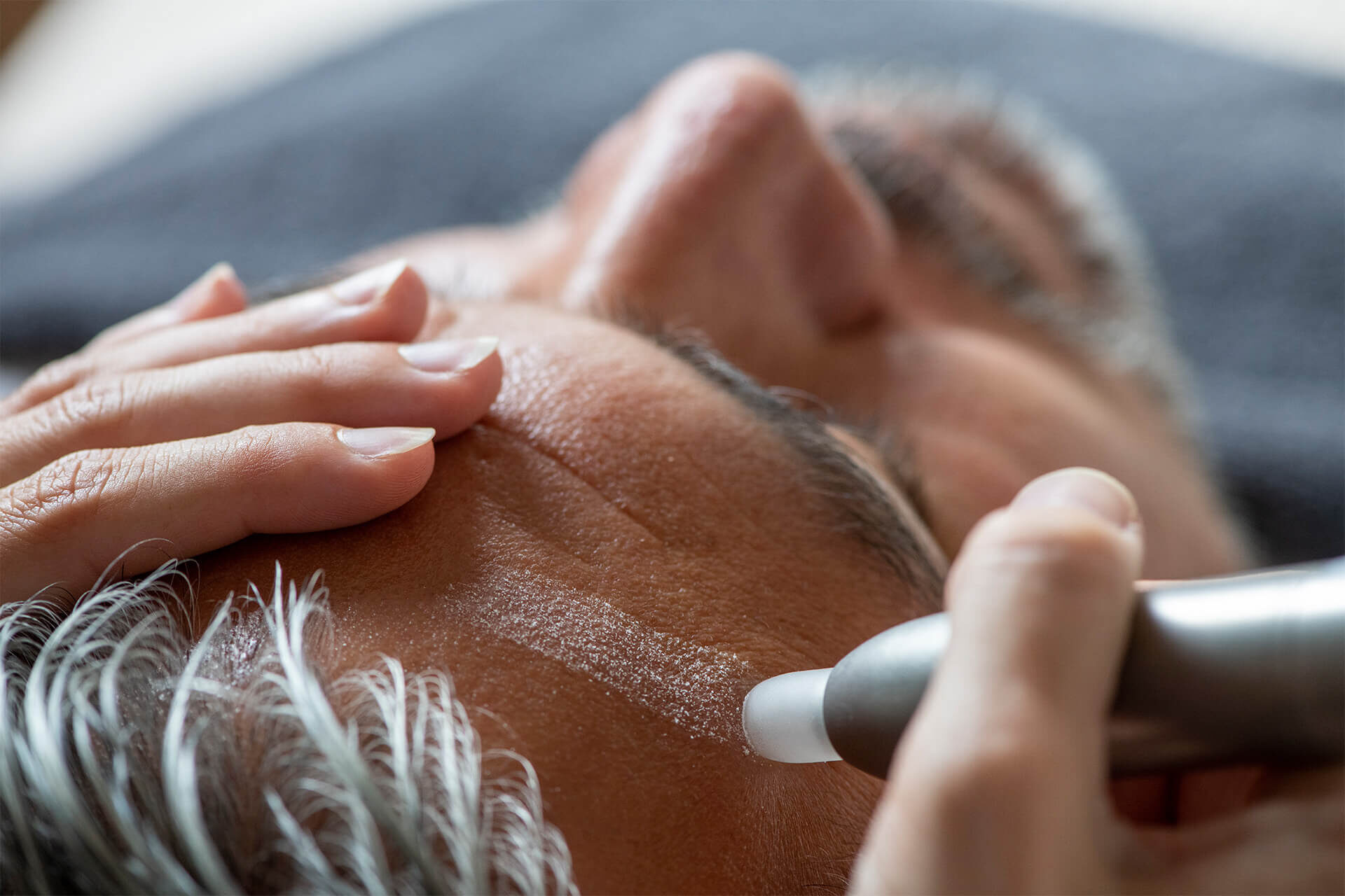 Microdermabrasie behandeling op het voorhoofd