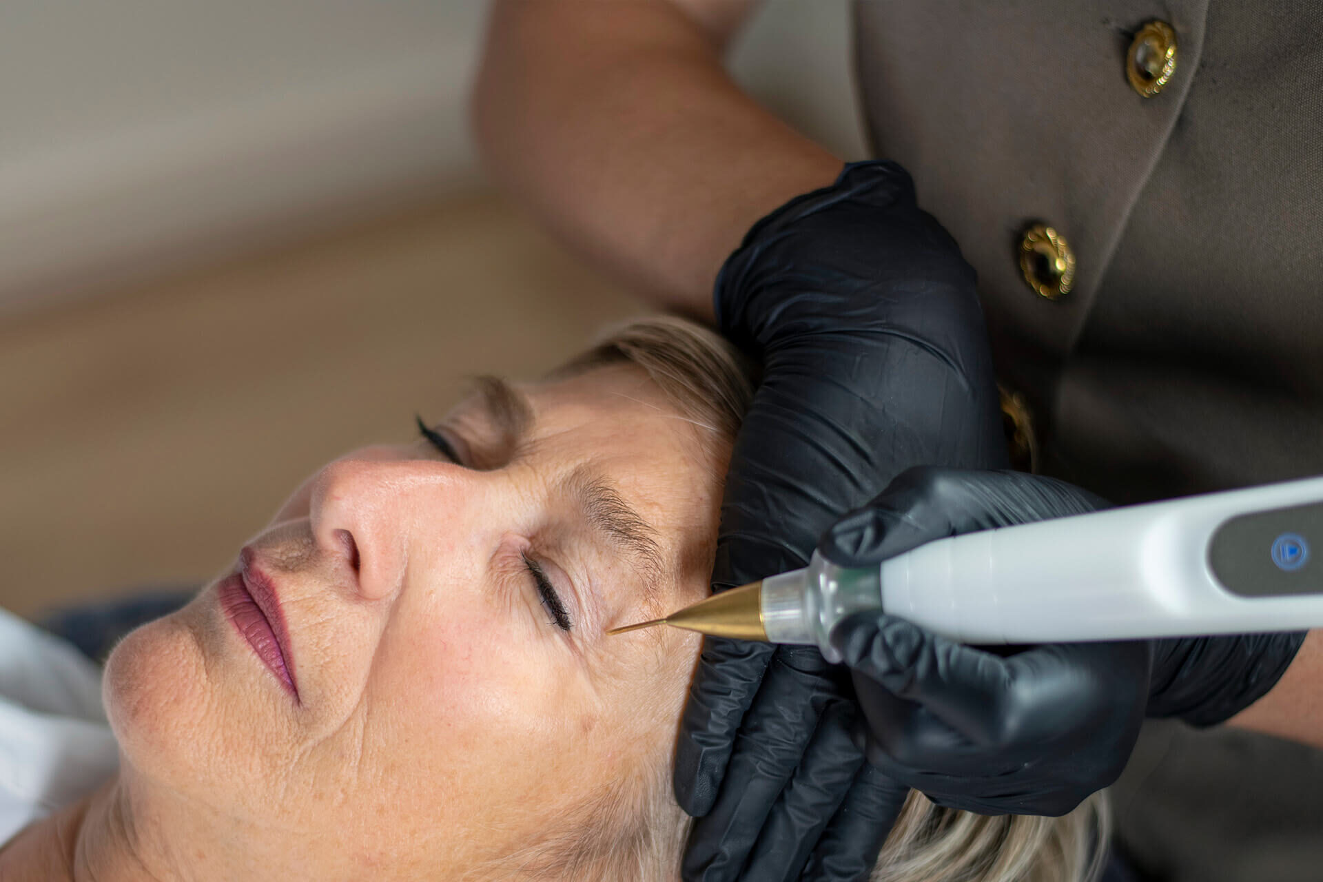 Plasma lift voor een ooglid correctie van de oogleden