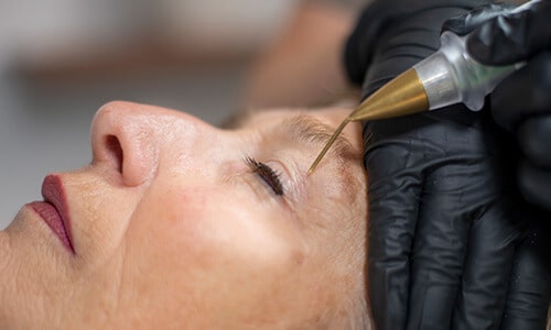 Plasma lift behandeling voor het verstrakken van oogleden