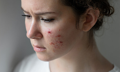Rosacea is een vervelende huidaandoening