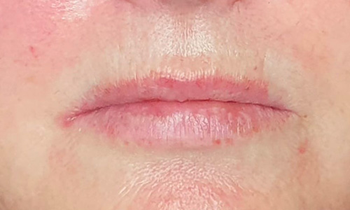 lippen voor de behandeling