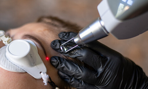 Yag laser voor het verwijderen van permanente make-up